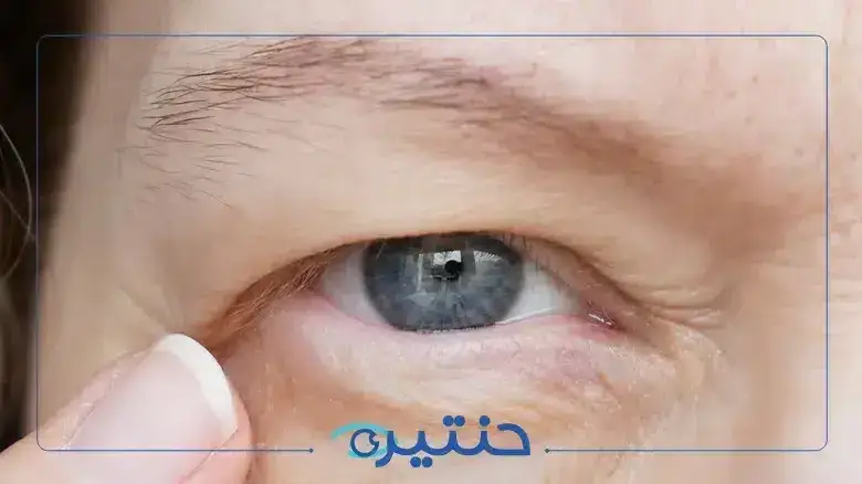 كسل العين