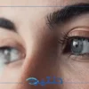 المرشحون لعملية جحوظ العين