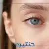كسل العين