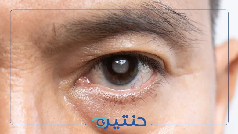 نصائح بعد عملية المياه البيضاء نصائح بعد عملية المياه البيضاء