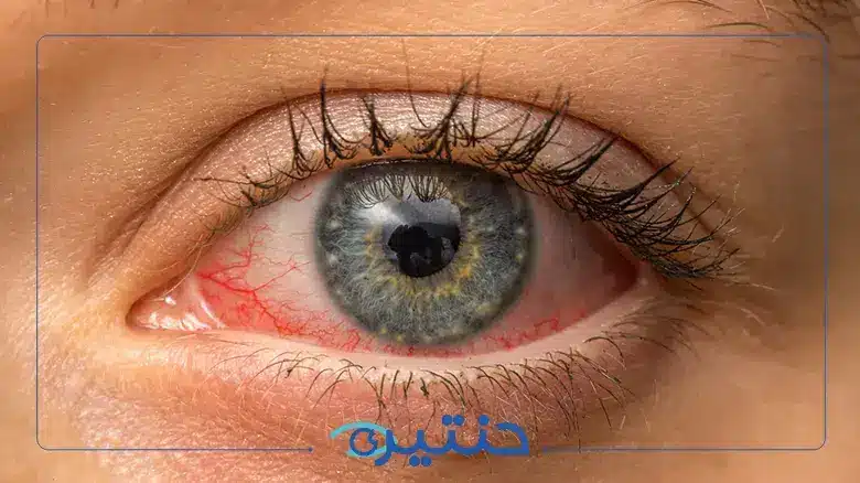 أمراض الشبكية الوراثية