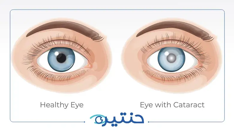 إزالة المياه البيضاء