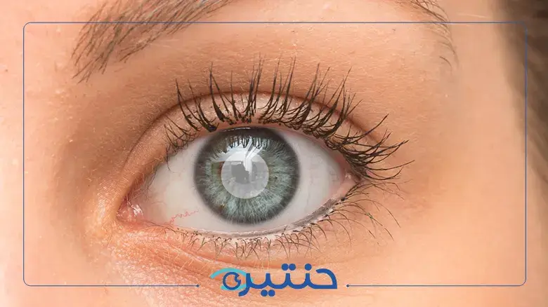 إزالة المياه البيضاء