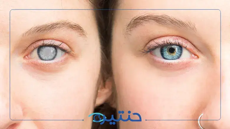 إزالة المياه البيضاء