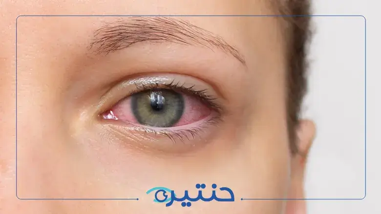 أسباب جفاف العين