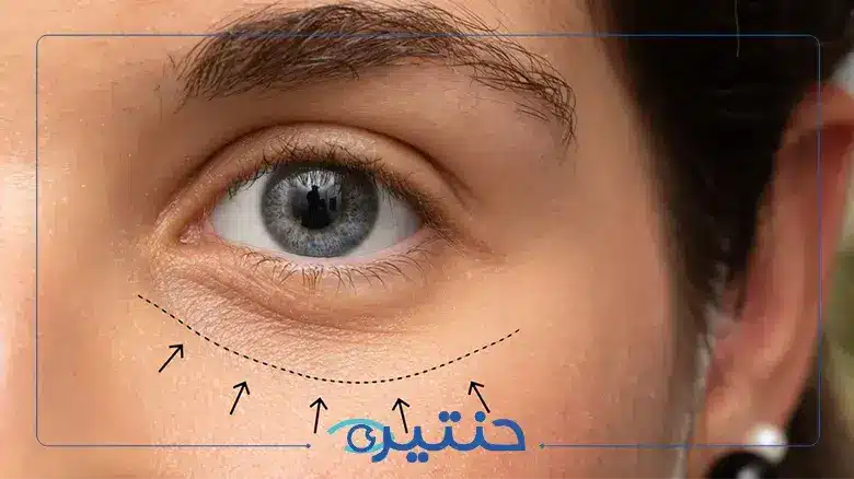 حقن البوتكس تحت العين
