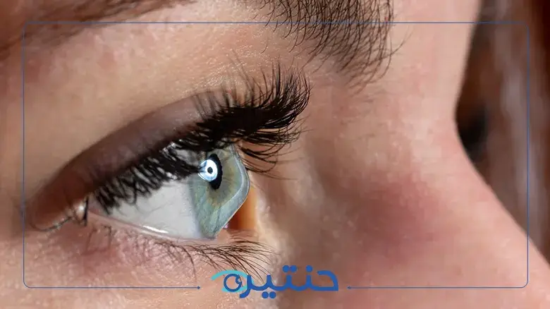 ما هي القرنية المخروطية وطرق علاجها
