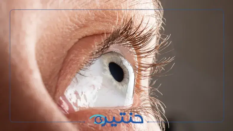 ما هي القرنية المخروطية وطرق علاجها