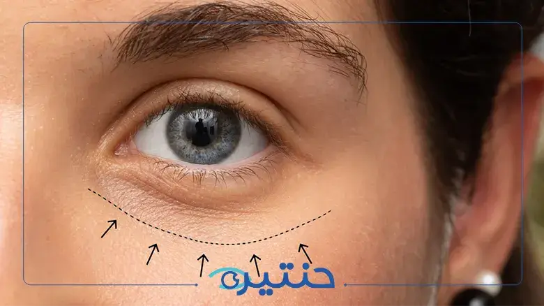 حقن البوتكس تحت العين حقن البوتكس تحت العين