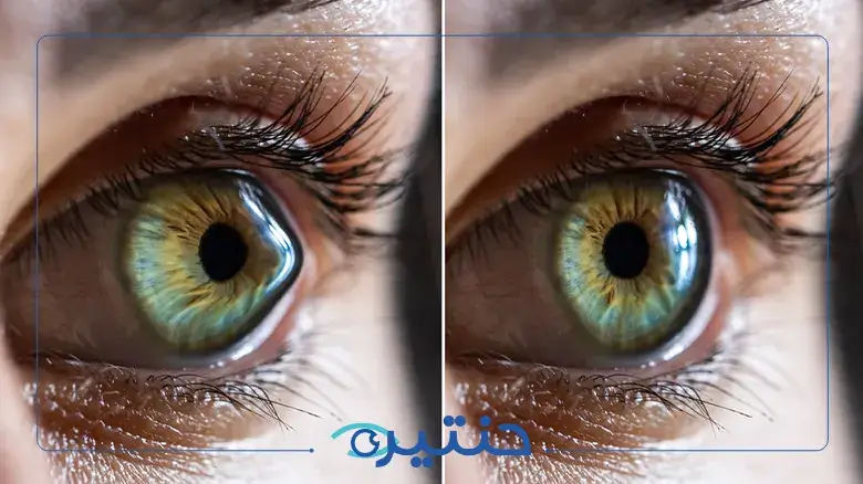 ما هي القرنية المخروطية وطرق علاجها