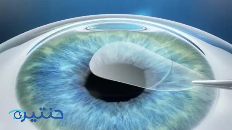 عملية الفيمتو سمايل لتصحيح النظر Femto Smile eye surgery عملية الفيمتو سمايل لتصحيح النظر Femto Smile eye surgery