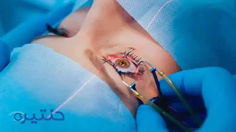 عملية الليزر السطحي Surface laser surgery