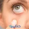 أسباب التهاب الجفون وخيارات العلاج