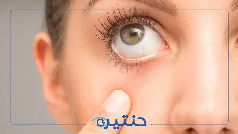 أسباب التهاب الجفون وخيارات العلاج