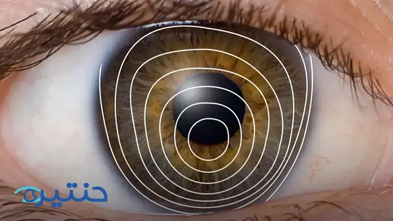 علاج القرنية المخروطية Keratoconus treatment علاج القرنية المخروطية Keratoconus treatment
