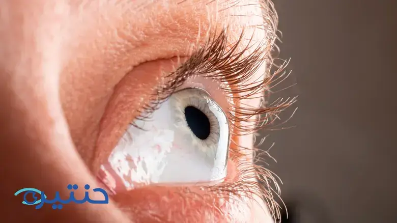 علاج القرنية المخروطية Keratoconus treatment علاج القرنية المخروطية Keratoconus treatment