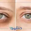 أضرار قلة النوم على العين