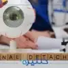 أعراض انفصال الشبكية المبكرة