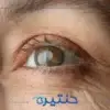 عودة المياه البيضاء بعد العملية