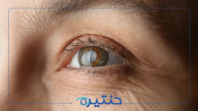 عودة المياه البيضاء بعد العملية