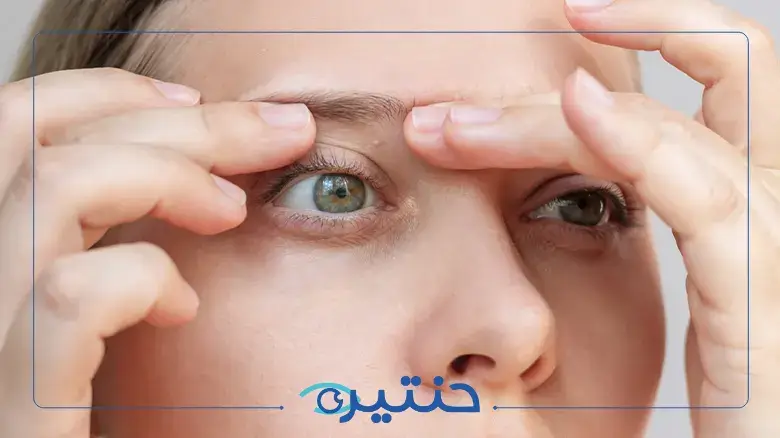 الأكياس الدهنية بالجفن