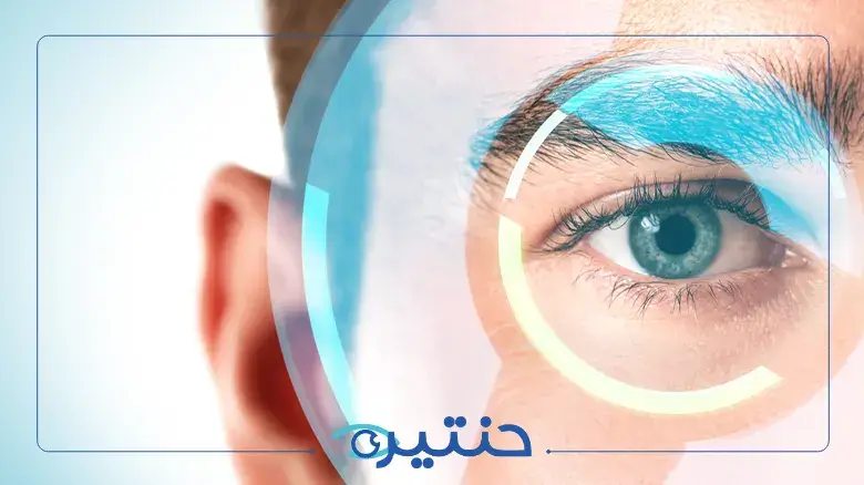 السوبراكور ليزك