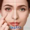 علاج احمرار العين في المنزل
