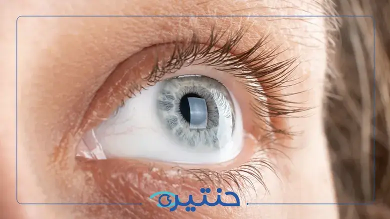 الفرق بين زراعة القرنية الكاملة والطبقية