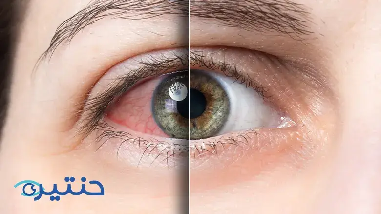 تشخيص وعلاج جفاف العين