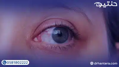 أنواع التهابات القرنية