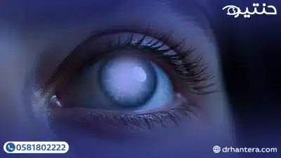 مخاطر إهمال المياه البيضاء