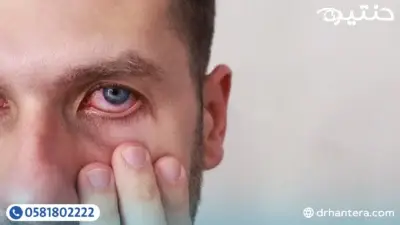 احمرار العين بعد العملية طبيعي ولا يستدعي القلق؟