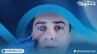 أنواع العدسات التي تُزرع داخل العين