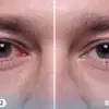 احمرار العين بعد العملية هل هو أمر طبيعي أم يستدعي القلق؟