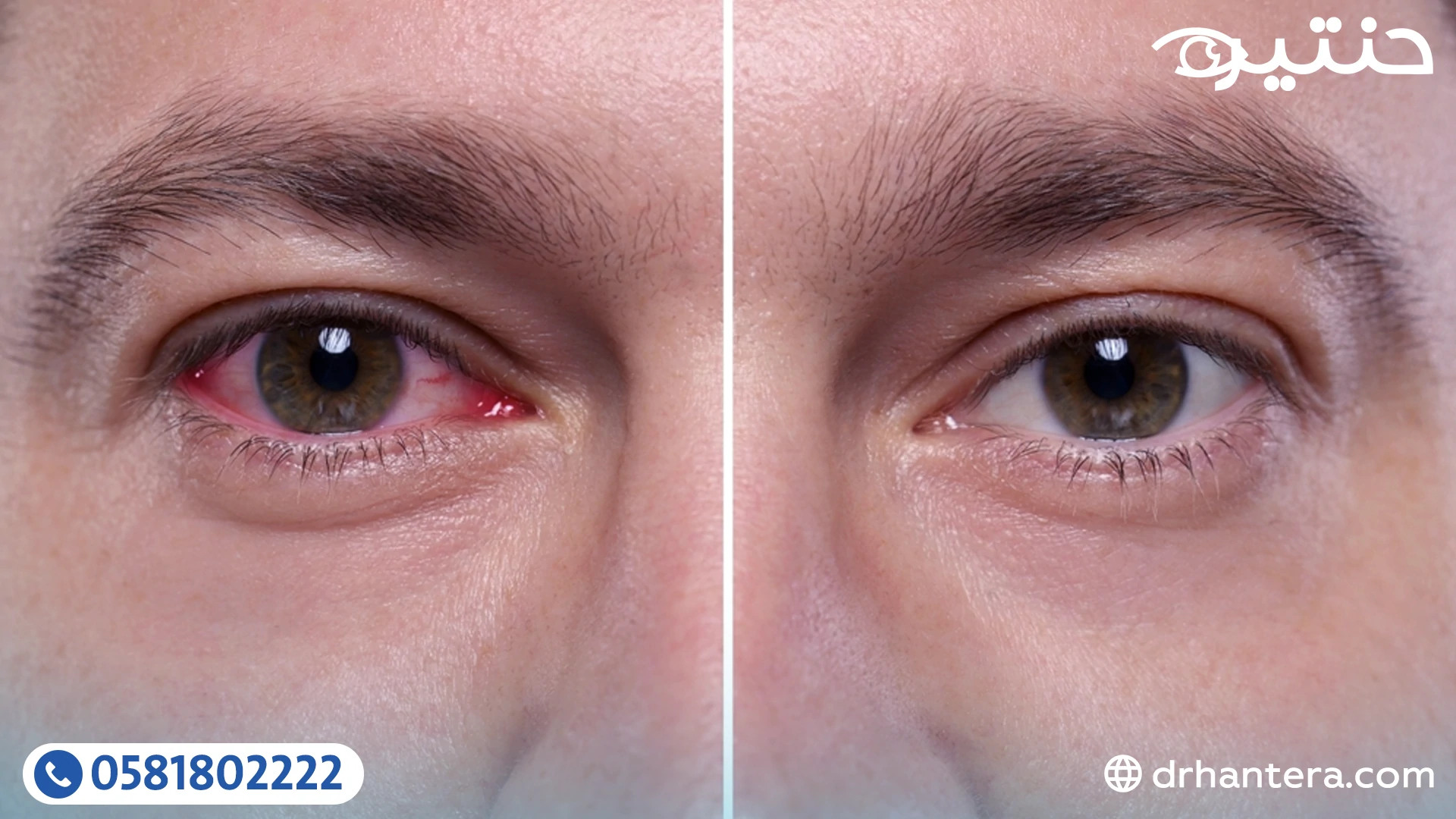 احمرار العين بعد العملية هل هو أمر طبيعي أم يستدعي القلق؟