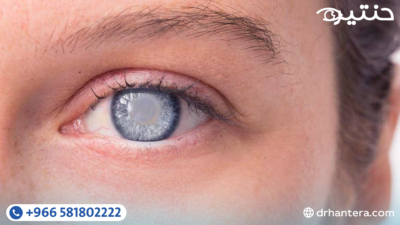 الفرق بين المياه البيضاء والمياه الزرقاء والمياه السوداء في العين دليل شامل ومبسط 1 الفرق بين المياه البيضاء والمياه الزرقاء والمياه السوداء في العين