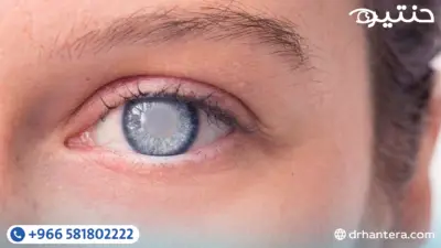 الفرق بين المياه البيضاء والمياه الزرقاء والمياه السوداء في العين دليل شامل ومبسط 1 الفرق بين المياه البيضاء والمياه الزرقاء والمياه السوداء في العين