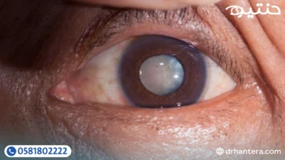 المياه البيضاء والمياه الزرقاء والمياه السوداء: إيه الفرق بينهم؟ وهل فعلًا في مياه جوه العين؟