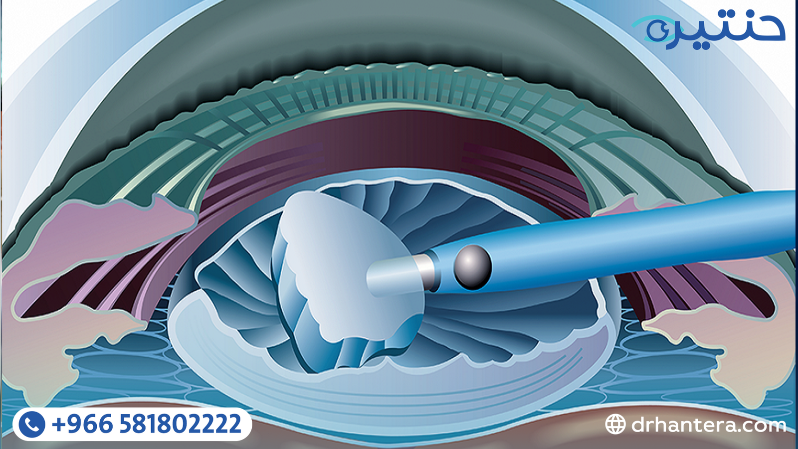 علاج المياه البيضاء بالموجات فوق الصوتية الفاكو كيف تُجرى العملية خطوة بخطوة؟