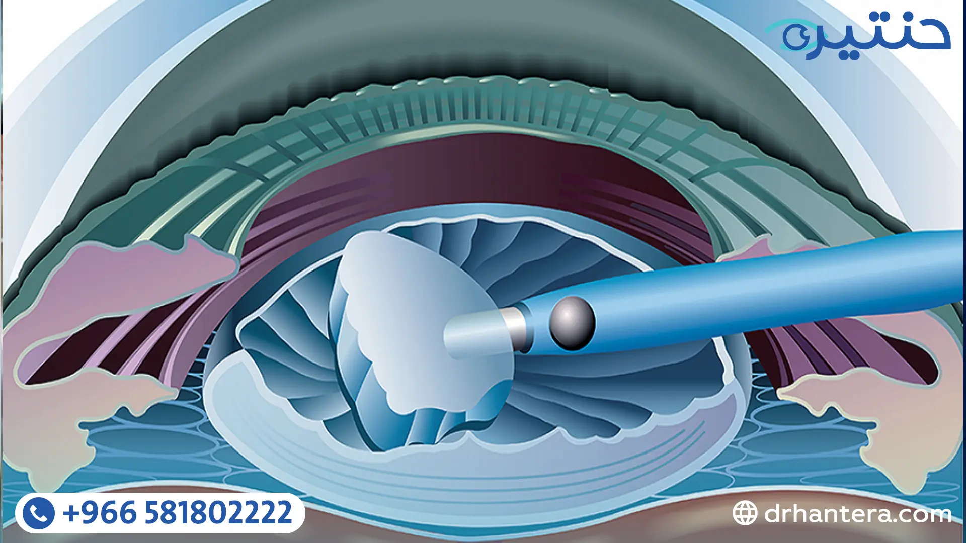 علاج المياه البيضاء بالموجات فوق الصوتية الفاكو كيف تُجرى العملية خطوة بخطوة؟