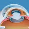 هل كل عمليات المياه البيضاء تتضمن زراعة عدسة؟ وما هو أفضل نوع يناسبك؟