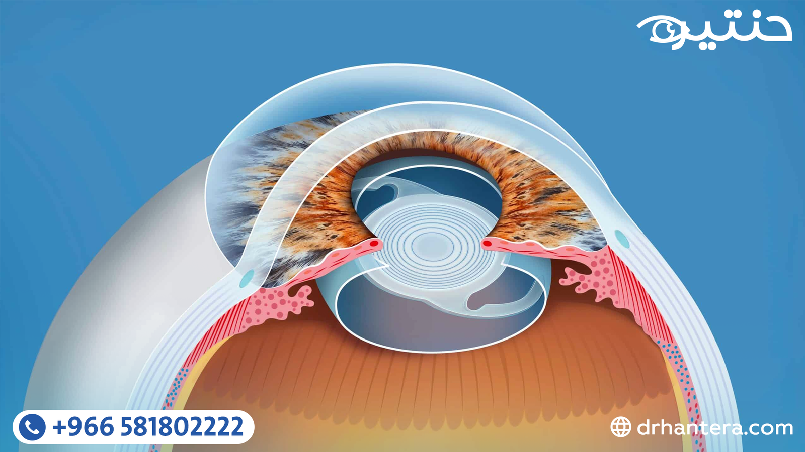 هل كل عمليات المياه البيضاء تتضمن زراعة عدسة؟ وما هو أفضل نوع يناسبك؟