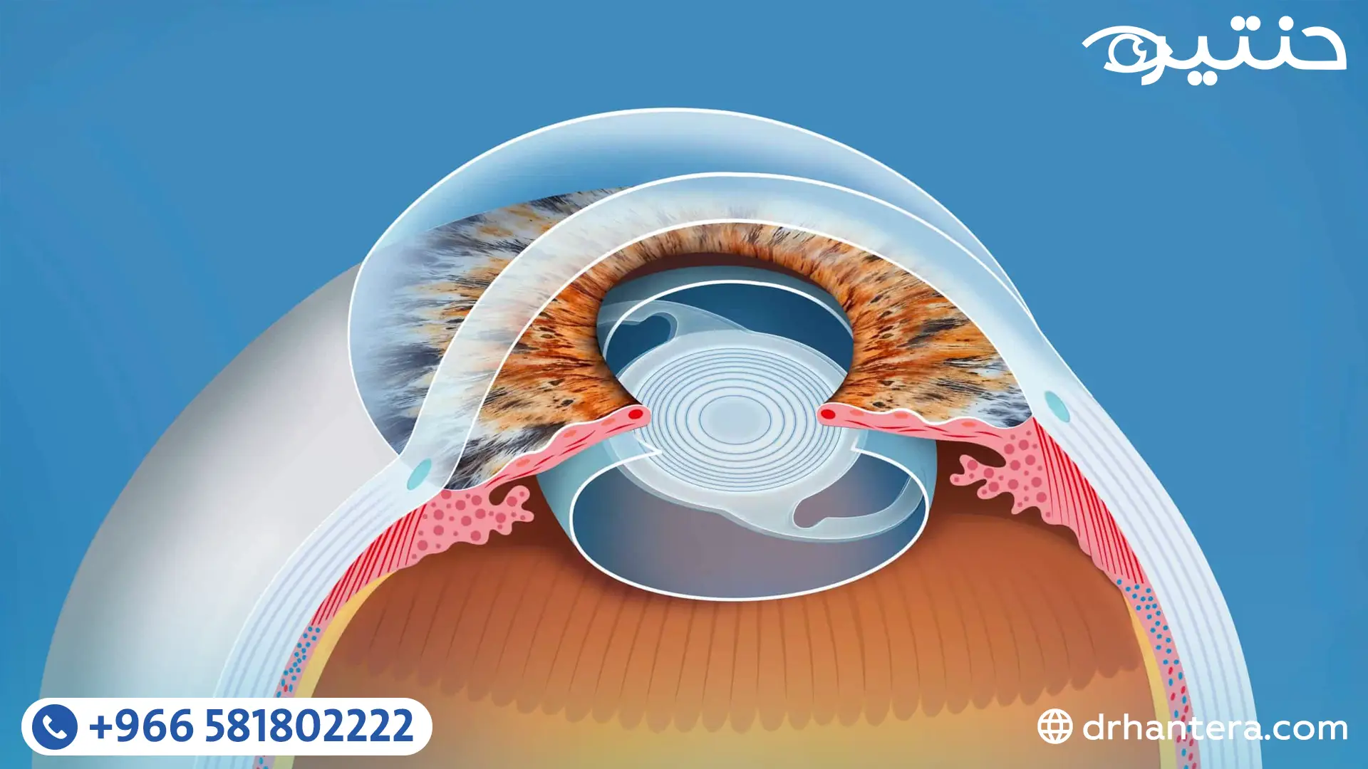 هل كل عمليات المياه البيضاء تتضمن زراعة عدسة؟ وما هو أفضل نوع يناسبك؟