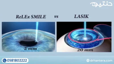ما الفرق بين الفيمتو سمايل والليزك؟ وكيف يتم اختيار العملية المناسبة؟ 1 ما الفرق بين الفيمتو سمايل والليزك؟ وكيف يتم اختيار العملية المناسبة؟