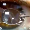 أنواع العدسات التي تُزرع داخل العين