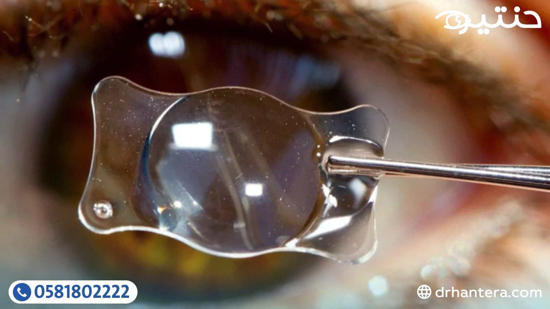 أنواع العدسات التي تُزرع داخل العين