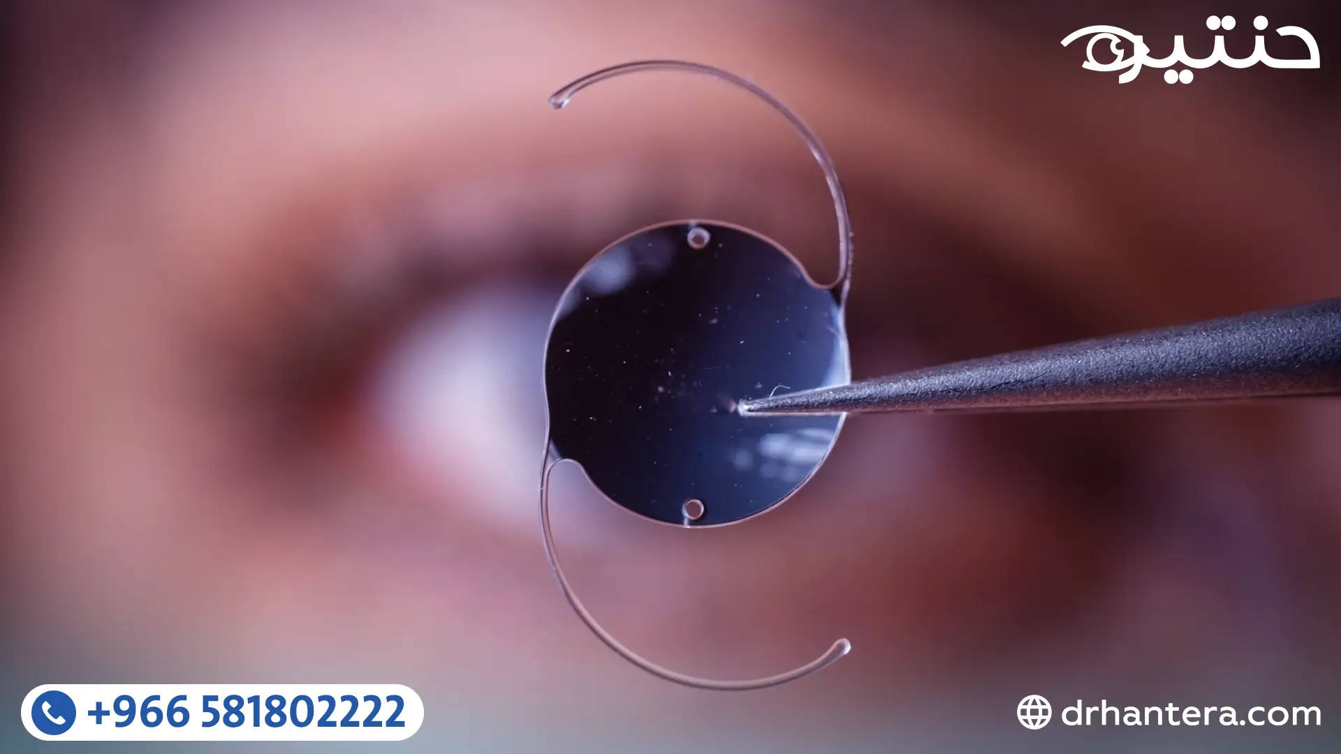 التحضير لعملية المياه البيضاء وزراعة العدسة ماذا تفعل قبل يوم الجراحة؟