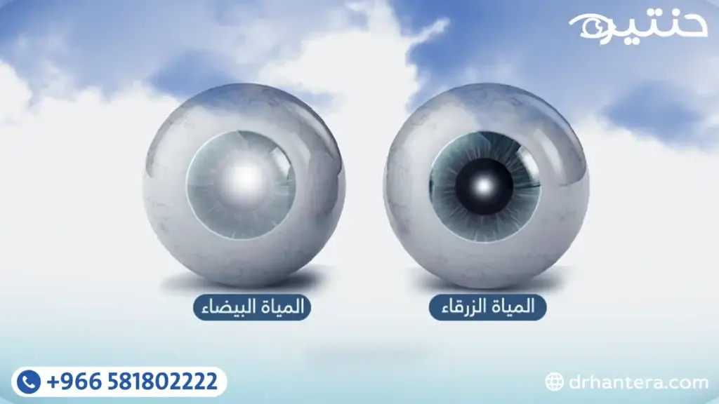 الفرق بين المياه البيضاء والمياه الزرقاء والمياه السوداء في العين