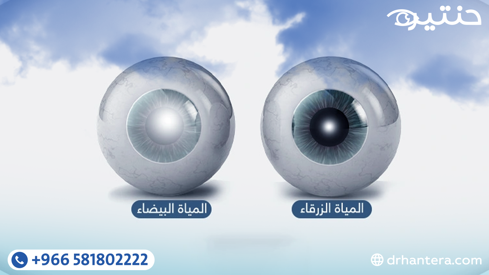 الفرق بين المياه البيضاء والمياه الزرقاء والمياه السوداء في العين