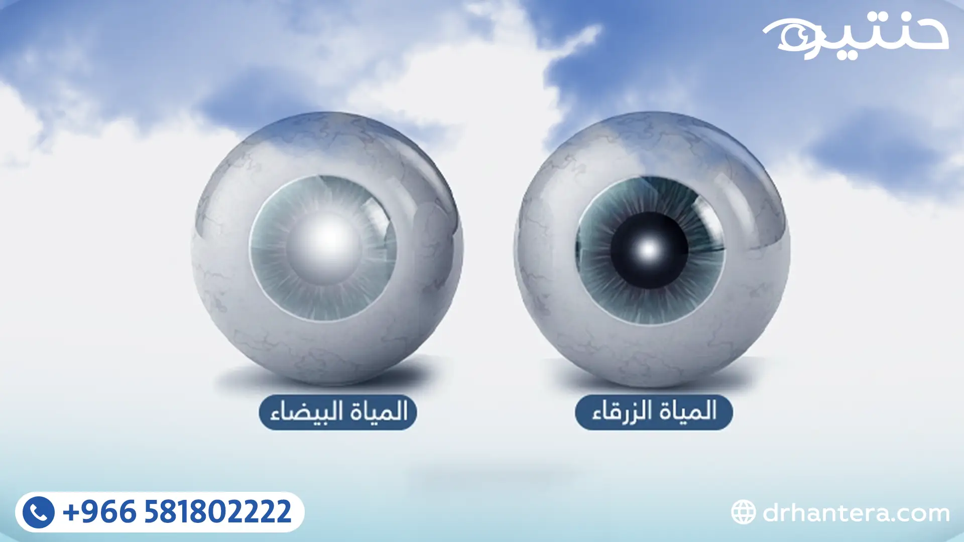 الفرق بين المياه البيضاء والمياه الزرقاء والمياه السوداء في العين